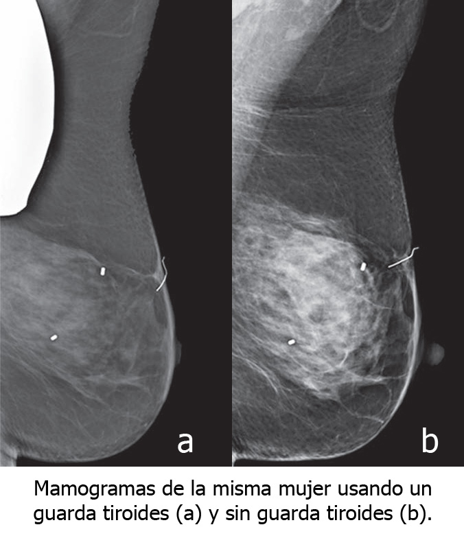 mamogramas